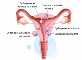 Особенности течения рака шейки матки второй стадии
